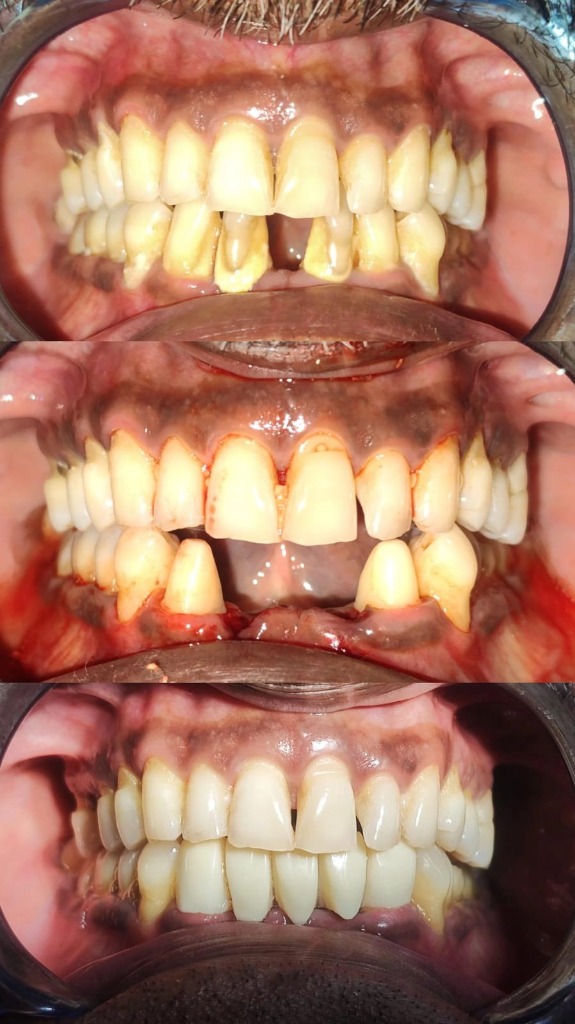 Teeth Replacement: Fixed Crown & Bridge Transformation