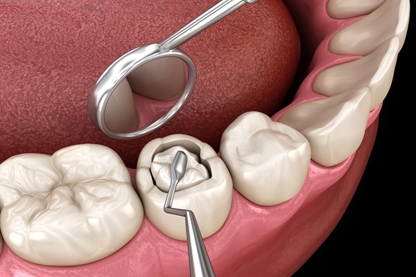 Tooth Filling