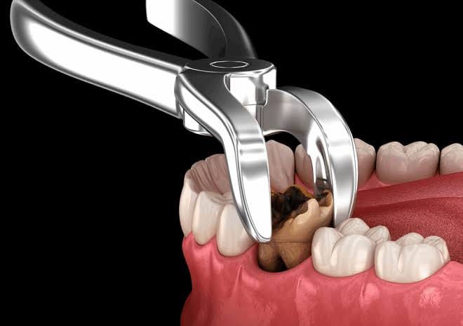 Teeth Extraction