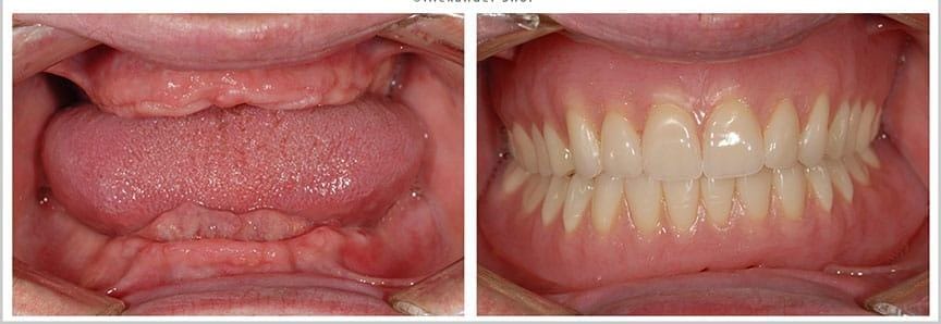 Complete Denture