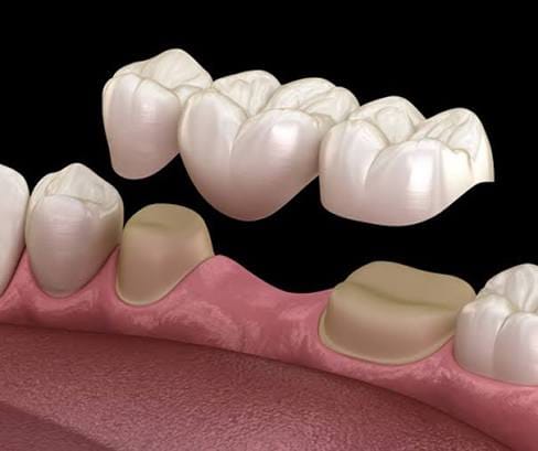Teeth Replacement (Crown and Bridge)